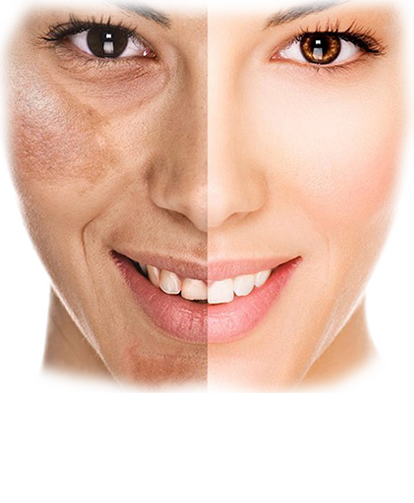 Pigmentation Treatments