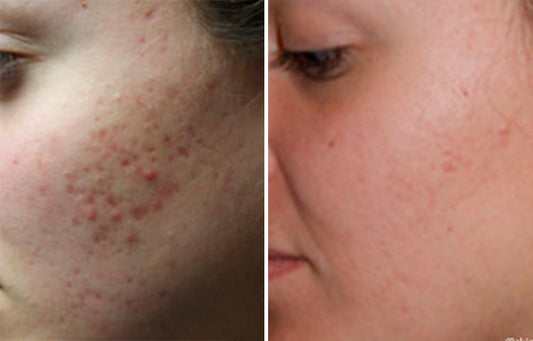 Acne Marks / Scars Treatments