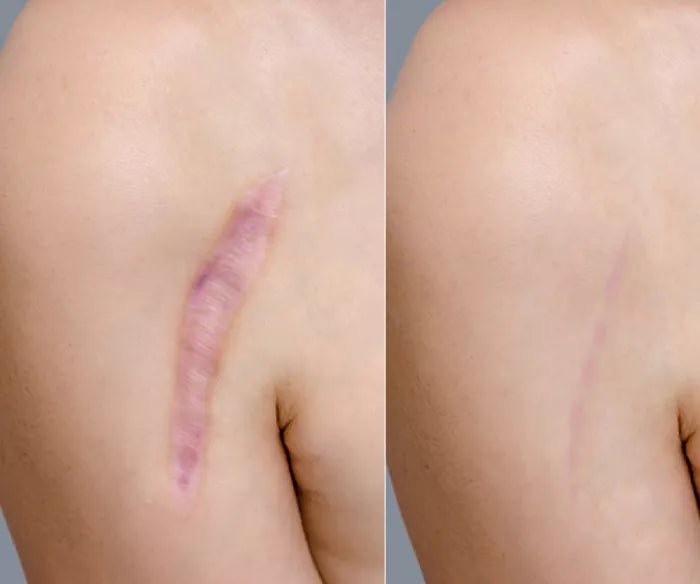 Acne Marks / Scars Treatments