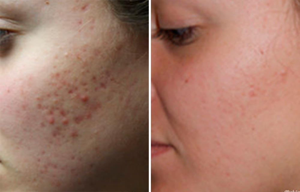 Acne Marks / Scars Treatments