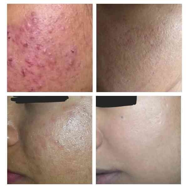 Acne Marks / Scars Treatments