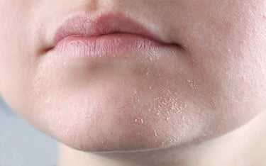 Dry & Dehydrated Skin Treatments